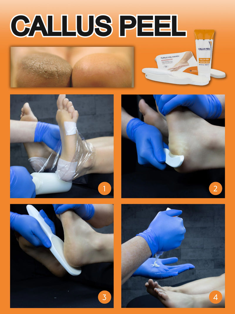 Callus Peel - Starter Kit (10-PACK)